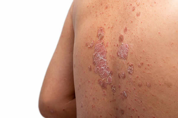 Intégrer les traitements naturels dans la gestion du psoriasis