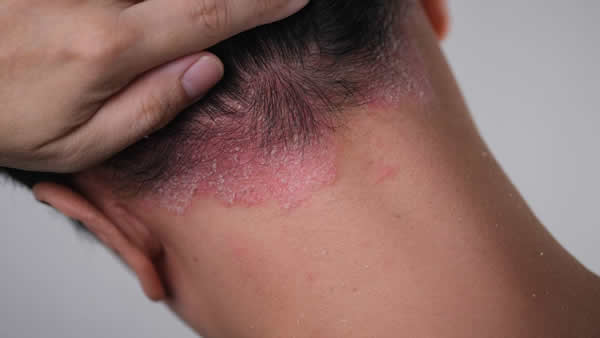 Le psoriasis au quotidien, quels traitements naturels ? 